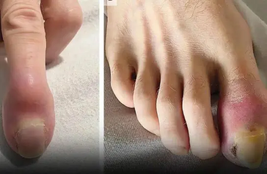 Man unexpectedly discovers finger "eaten" after 6 weeks of swelling and redness
