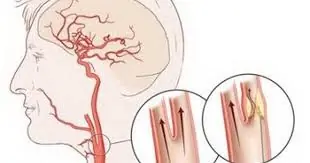 10 Silent Symptoms Of Clogged Arteries You Shouldn't Overlook