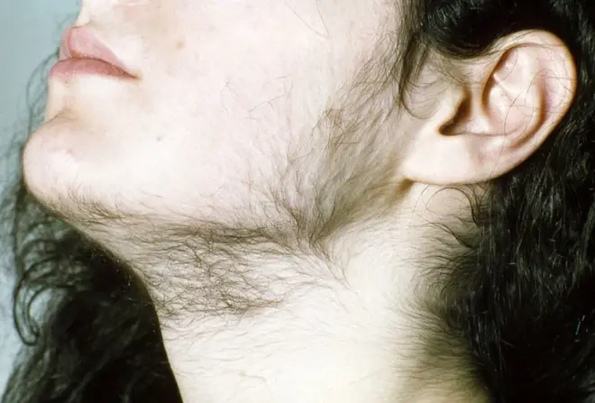Women With Excess Chin Hair: What Your Body May Be Trying to Tell You