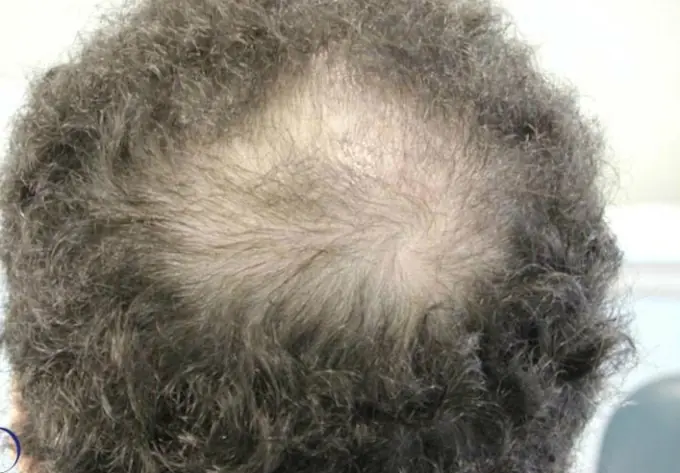 Baldness May Be a Sign of He.art Dise.ase