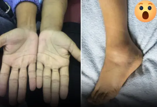Before can:cer arrive, hands and feet often have these 4 signs