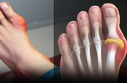 Those with gout should absolutely avoid these foods