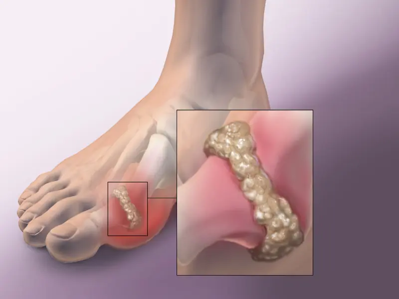 Some Foods Can Aggravate Gout Symptoms - Here's What You Should Know