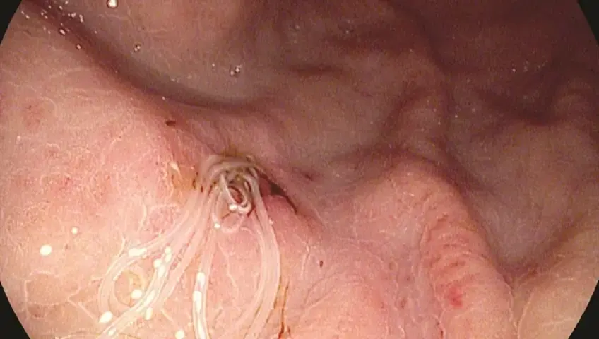 Warning: Eating These 4 Foods Improperly May Increase Your Risk of Parasite Infection