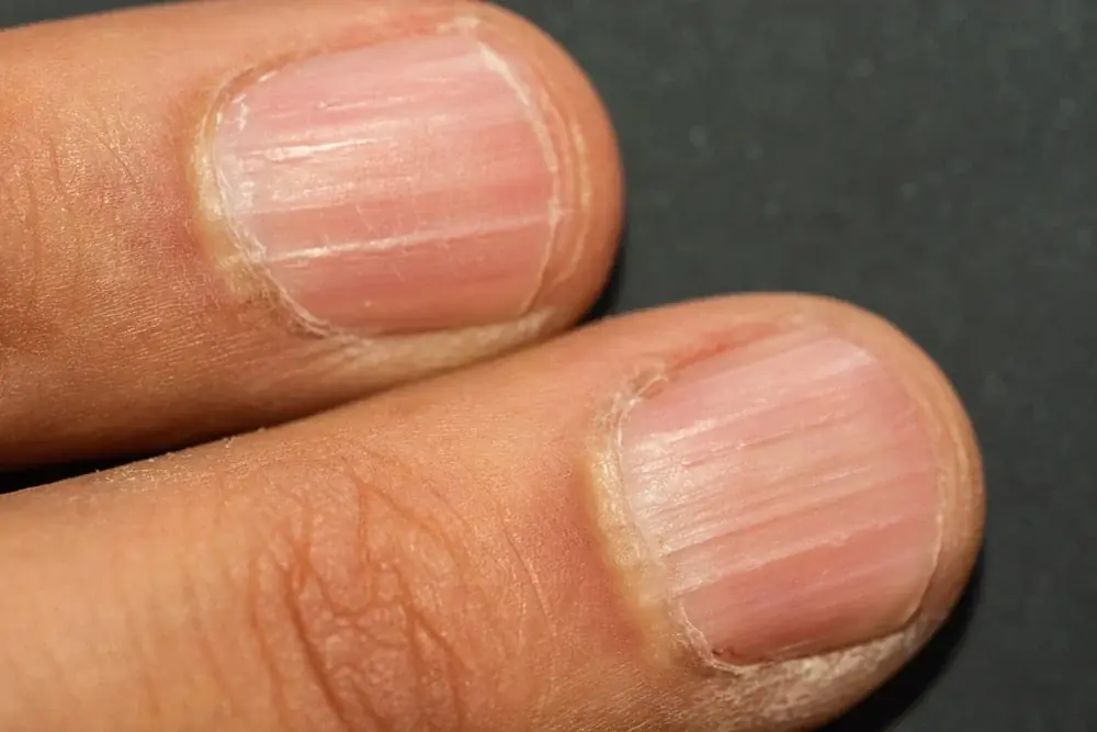 Lines on Your Nails Could Be More Than a Cosmetic Issue - Here's What They May Mean
