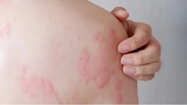 Hives May Have Surprising Triggers - Here's What You Should Know