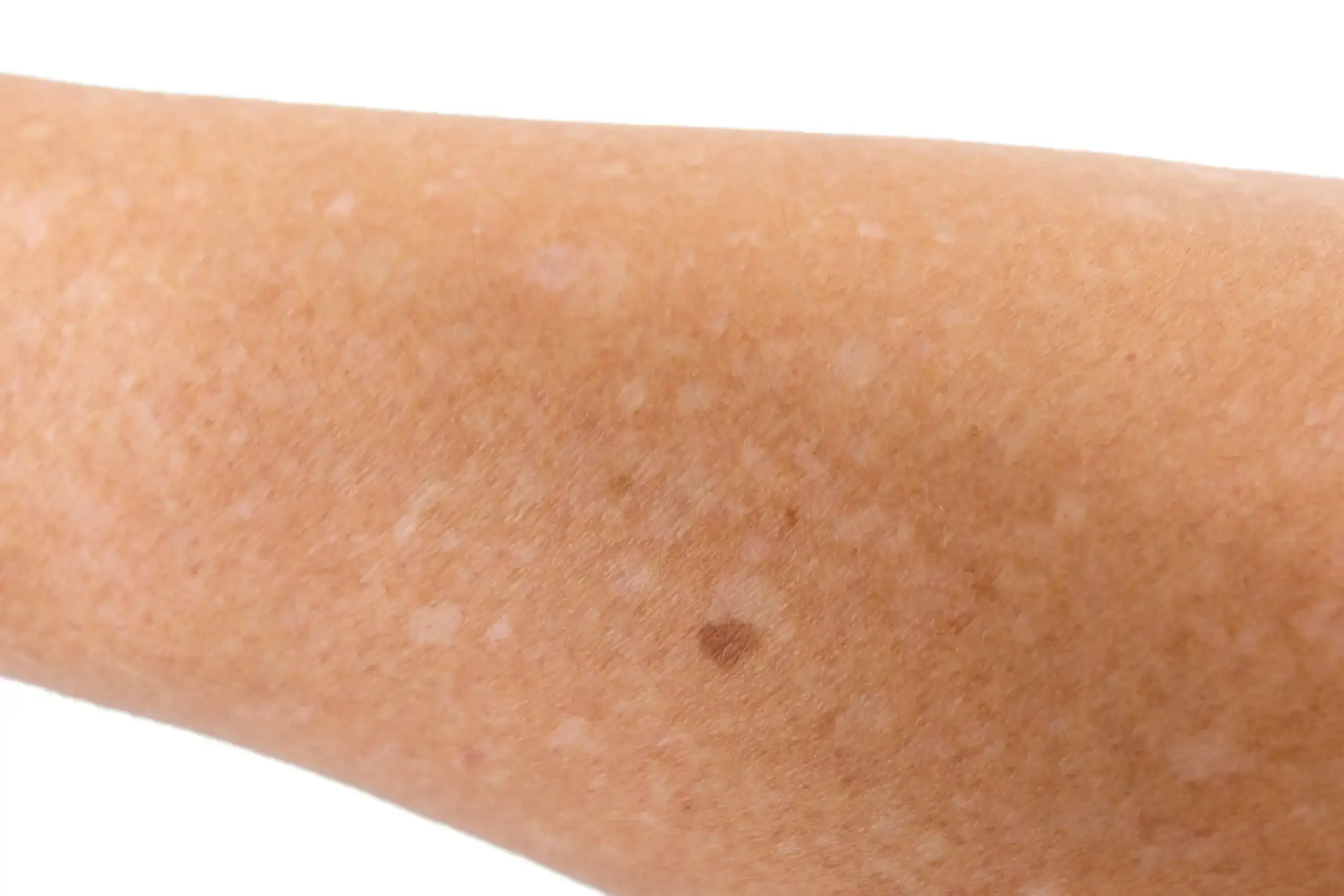 Those Little White Spots on Your Arms and Legs May Be Telling You Something