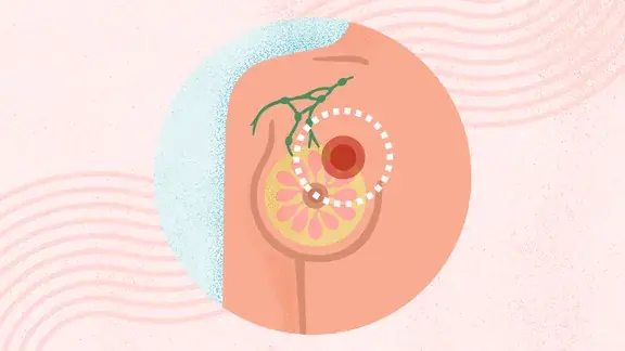 Don't Dismiss These Changes: They Could Be Early Warning Signs of Breast Cancer