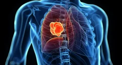 Lung Can.cer Can Be Difficult to Detect Early - Watch for These 5 Possible Symptoms