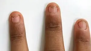 Doctors Say Your Nails May Offer Clues to Underlying Health Problems