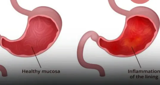 4 common mistakes when eating breakfast that seriously d.a.mage the stomach but few people notice
