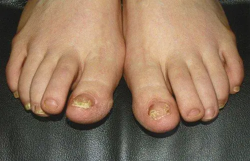 Pay Attention to These Foot Changes - They Could Be Related to Liver Health