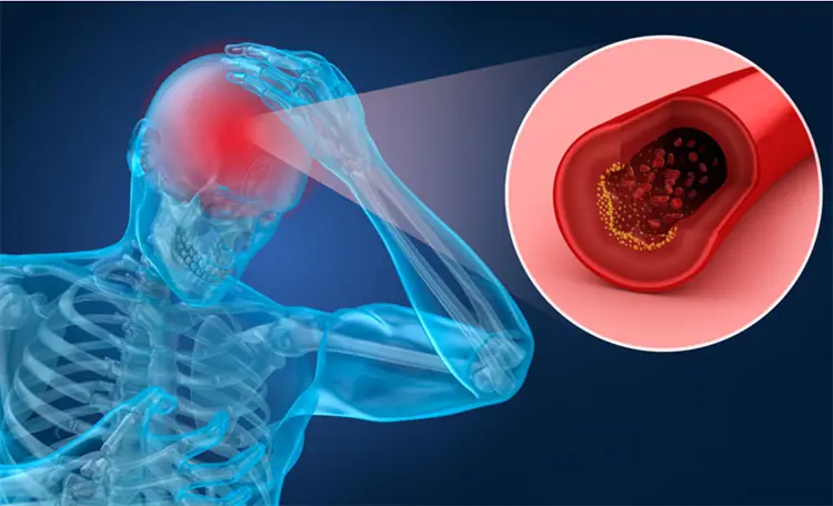 What You Should Know About Cerebral Ischemia: 5 Possible Risks and How to Reduce Them