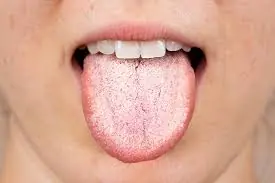 What a White Tongue May Be Telling You About Your Health?