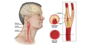 6 Simple Lifestyle Changes That Can Help Keep Your Arteries in Good Shape