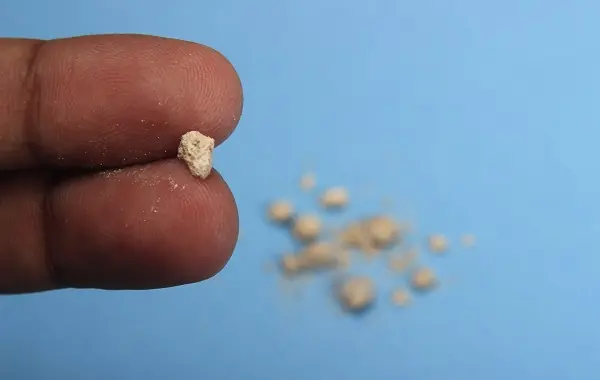 Woman, 58, Suffers Kid.ney Full of Pus and Severe Kid.ney Damage After Delaying Treatment for Stones
