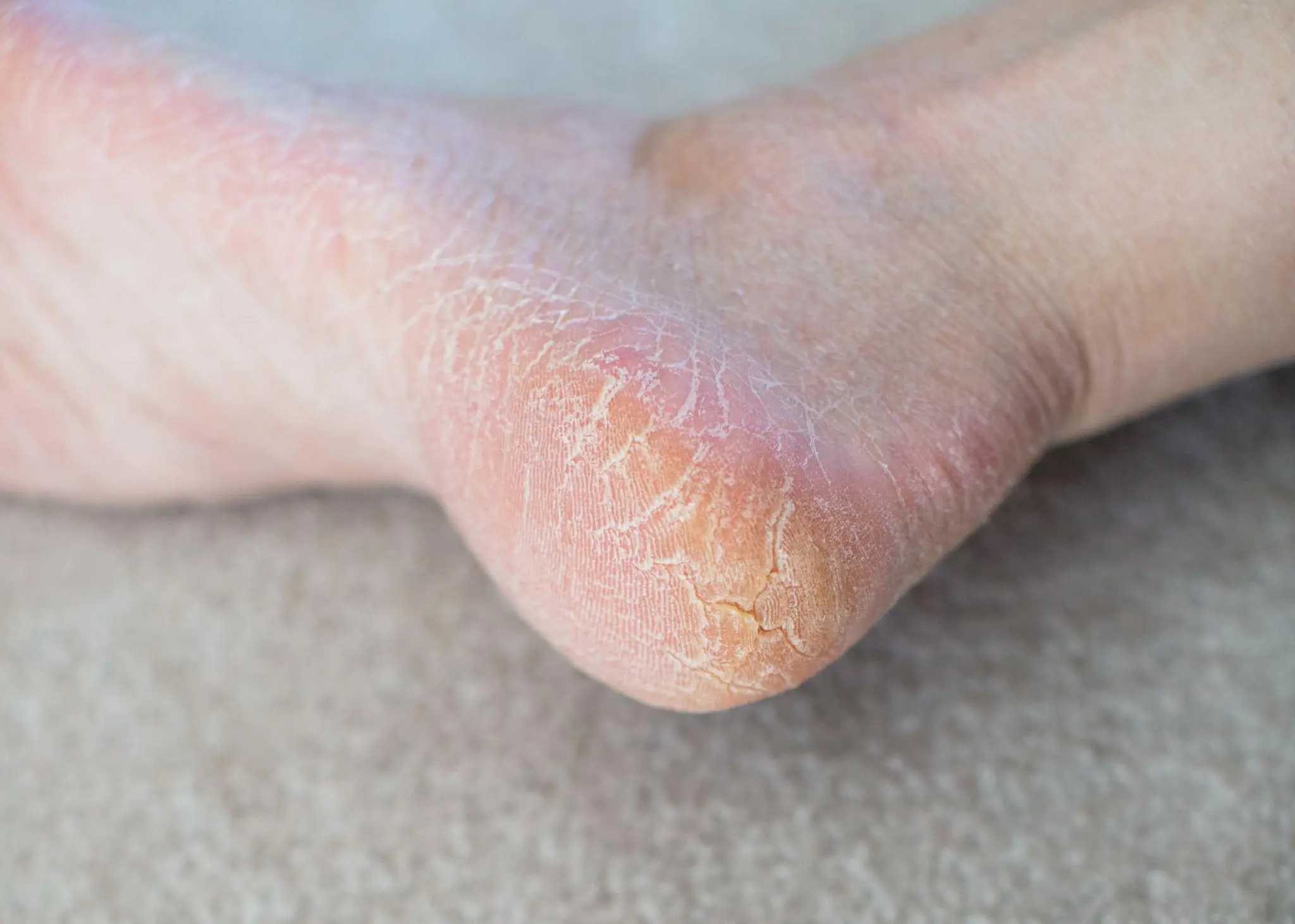 Persistent Cracked Heels Could Be Linked to More Than Just Lack of Moisture
