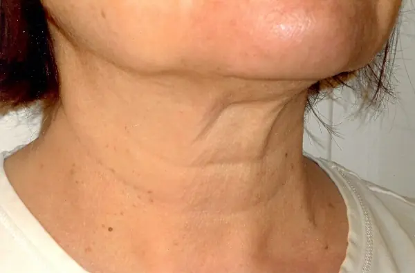 The Truth About Neck Sagging: Common Causes and What You Can Do About It