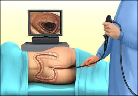 Many People Have Questions About Colonoscopies—Here's What You Need to Know