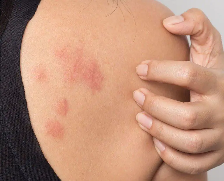 18 Signs of Histamine Intolerance: When It Looks Like an Allergy but May Be Something More