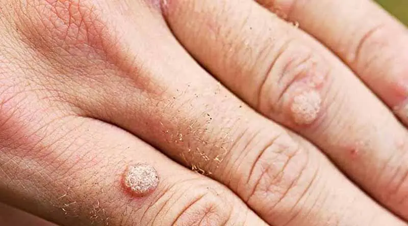 6 Common Types of Warts: Symptoms, Causes, Home Care, and Treatment Options