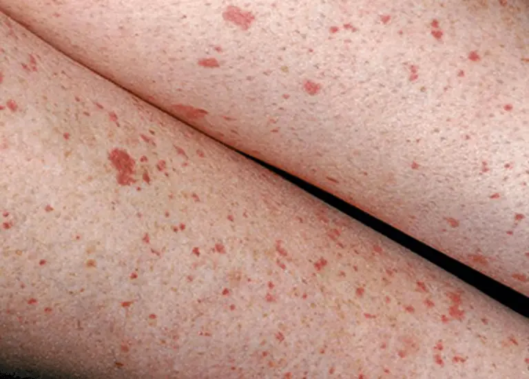 Red Dots on the Skin Can Have Many Causes – Here's What You Should Know
