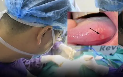 Two warning signs of tongue cancer are different from mouth ulcers