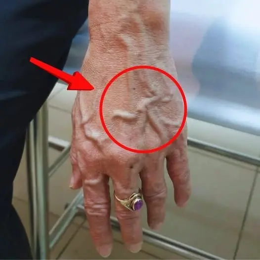 Visible Veins: What They May Reveal About Your Health and Body