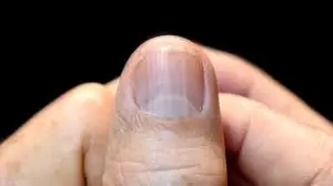 11 Nail Symptoms That Could Indicate an Underlying Health Condition