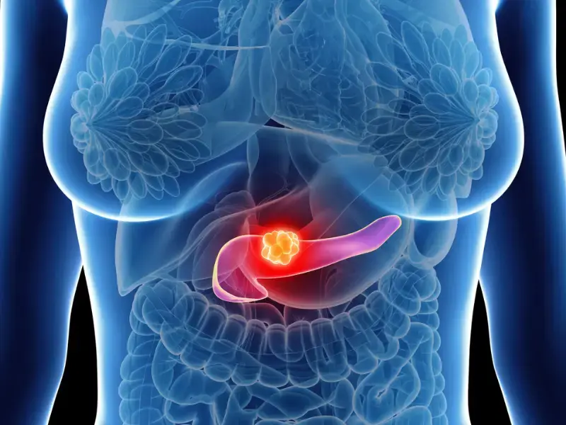 Pancreatic Cancer: 11 Early Symptoms That Deserve Attention