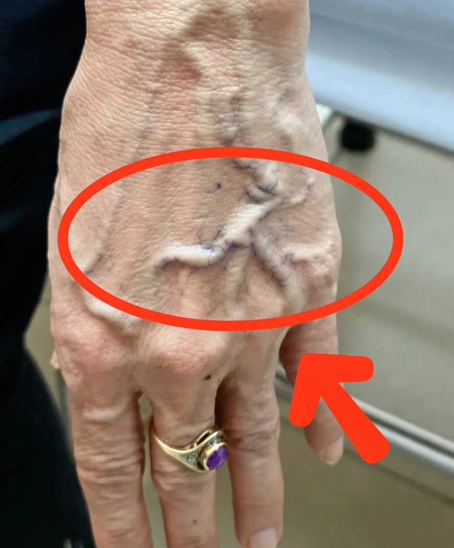 Visible Veins? Here's What They Could Reveal About Your Health
