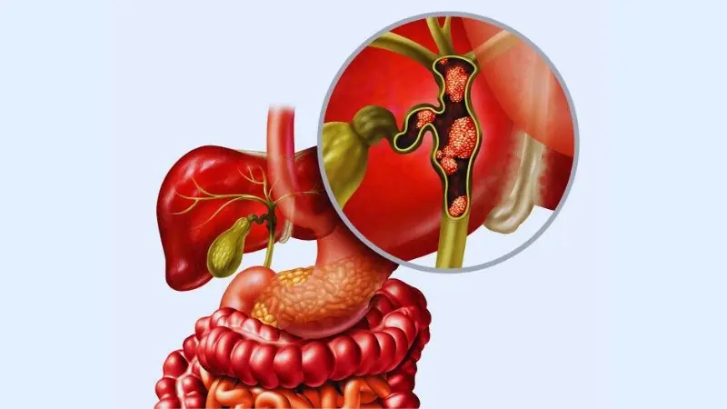 Gallstones Are More Common Than Many People Realize – Learn the Signs and How They're Treated