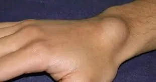 A Small Wrist Lump Could Have Several Possible Causes—Some May Require Attention