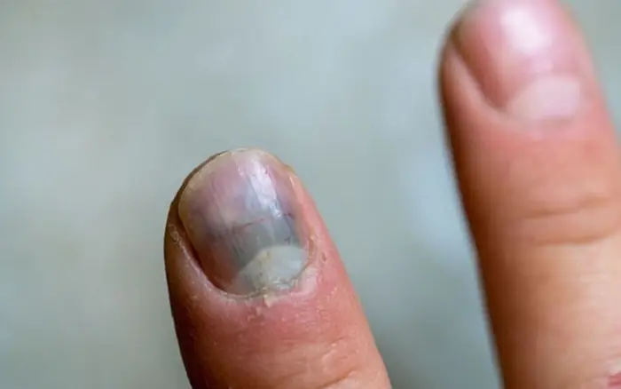 Certain Changes in the Fingers Can Sometimes Be Linked to Underlying Lung Conditions - Here's What to Look For