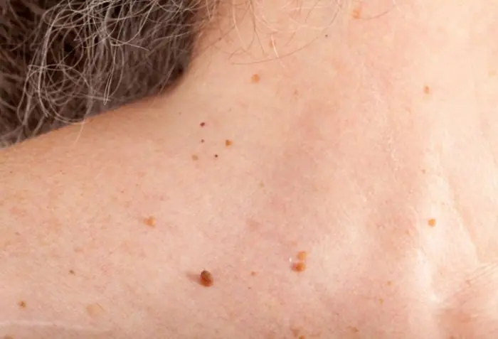 Skin Tags and Warts Are Common - Here's What You Need to Know About Treatment Choices