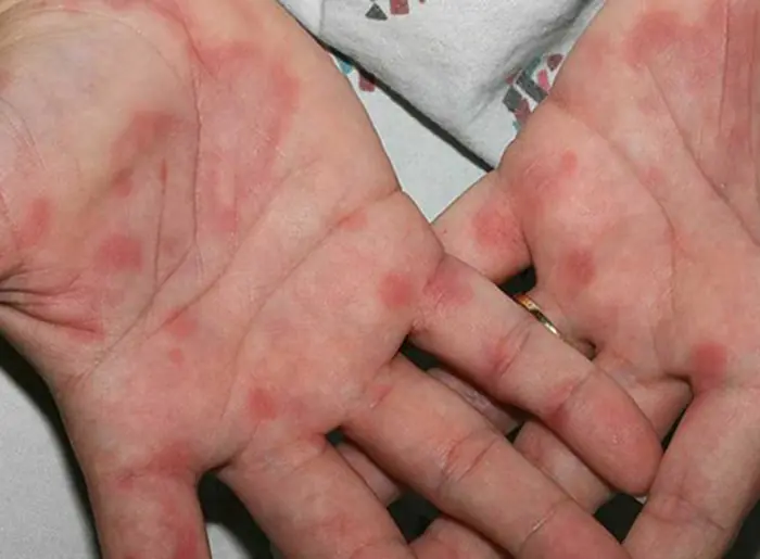 What Your Hands Might Be Telling You About Your Liver Health: Key Signs to Watch For