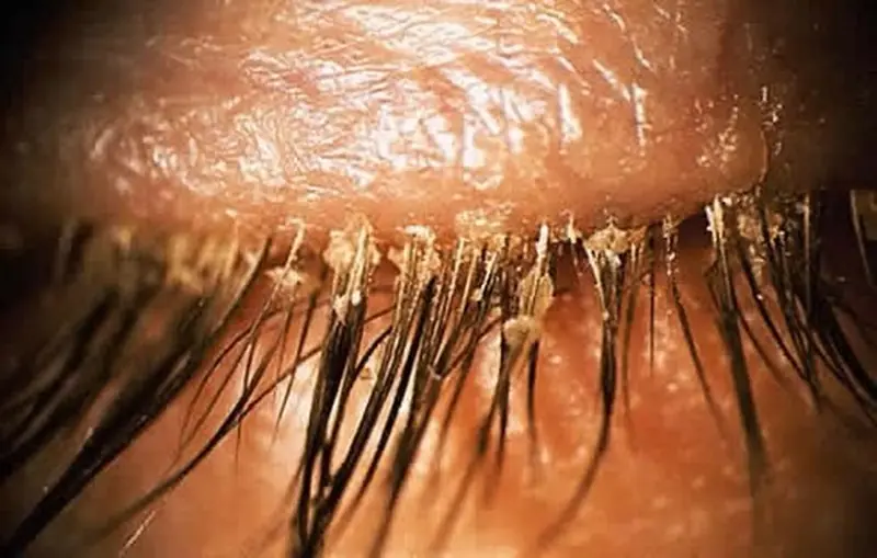 Stop Rubbing Your Eyes! The Real Reason Your Eyes Itch Every Morning May Be More Concerning Than You Think