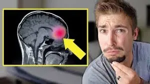 Could These Symptoms Be a Sign of an Aneurysm?