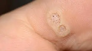 From Common Warts to Plantar Warts: The Key Differences Explained