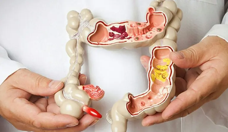 After a Stage 4 Colon Cancer Diagnosis, One Woman Shared 5 Symptoms She Initially Overlooked