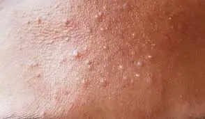 Before You Remove Those Tiny White Bumps, Here's the One Thing Experts Want You to Know