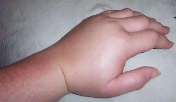 Unexpected Swelling in the Hands and Feet? Here's What Doctors Want You to Know