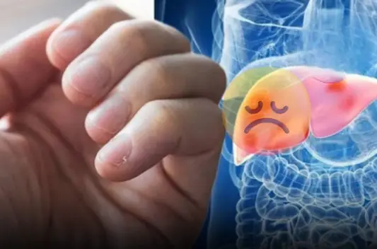 Don’t Ignore These 3 Hand Clues of Possible Liver Trouble