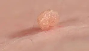 Thinking About Removing Skin Tags or Warts with Hydrogen Peroxide? Read This First