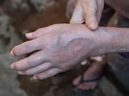 Why Are the Veins in Your Hands Suddenly More Visible? Experts Explain