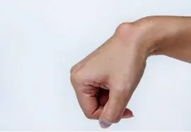 A Lump on Your Hand Doesn't Always Mean Something Serious — But It Should Be Checked