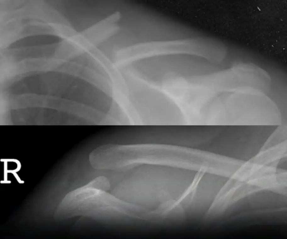 This Popular Everyday Drink Could Be Weakering Your Bones Without You Realizing