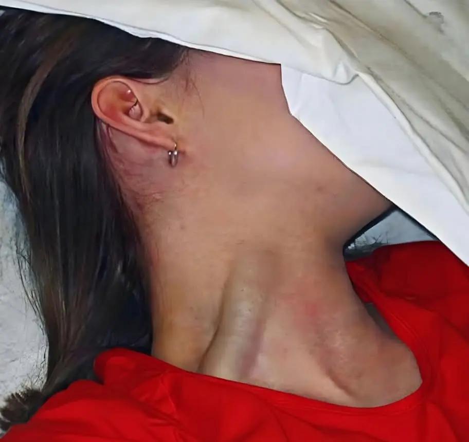 Bulging Neck Veins (Jugular Distension): What It Could Indicate