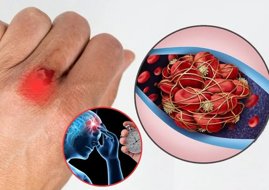 Stroke rarely comes without warning — these 9 silent brain clot signs can appear weeks earlier