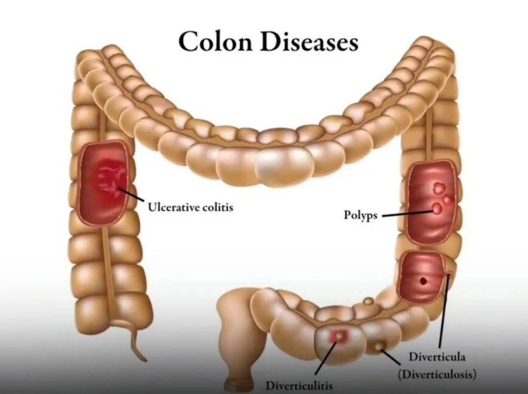 What Are the 5 Warning Signs of Colon Cancer? Here’s What to Know
